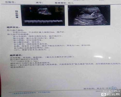 上海代孕2020:做B超发现卵巢囊肿